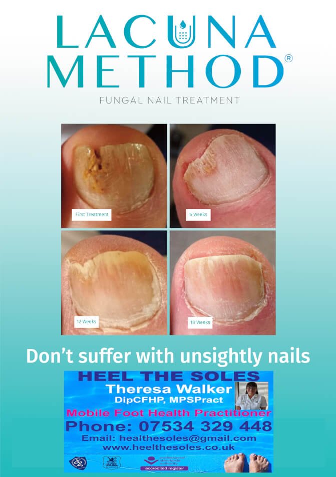 What Is Fungal Nail? Heel The Soles